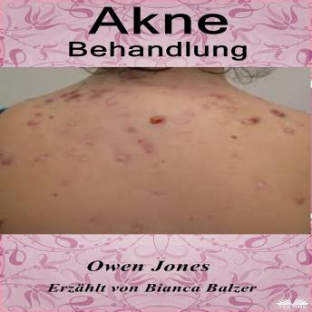 [German] - Akne-Behandlung